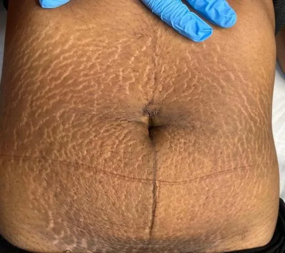 Abdômen antes e depois do tratamento de estrias com MicroPercut — antes