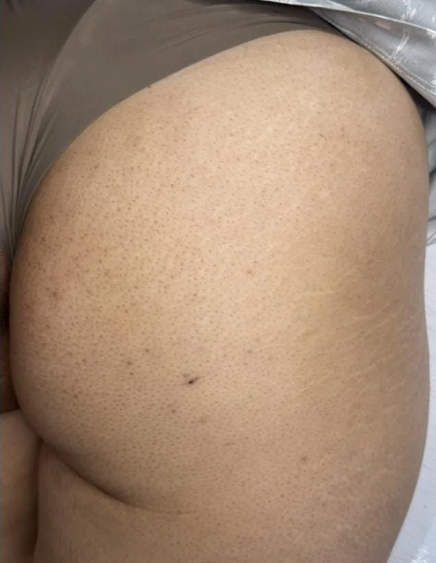 Glúteos antes e depois do tratamento de estrias com MicroPercut — depois