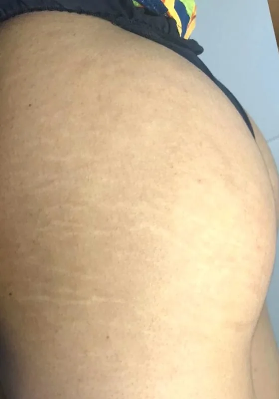 Glúteos antes e depois do tratamento de estrias com MicroPercut — depois